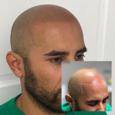 Hairline Restoration Scalp Micropigmentation SMP - Scalp Tattoo, Hair Loss Solutions