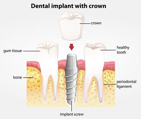 Affordable Dental Implants Arlington from $979, Single Tooth or Full Mouth. Solutions for Missing Teeth.