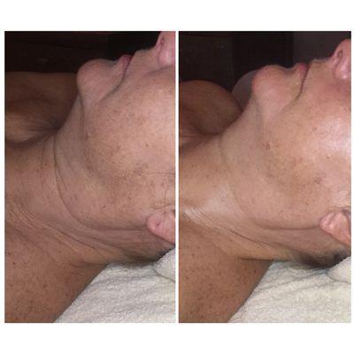 Before and after of one microcurrent treatment with chemical peel.