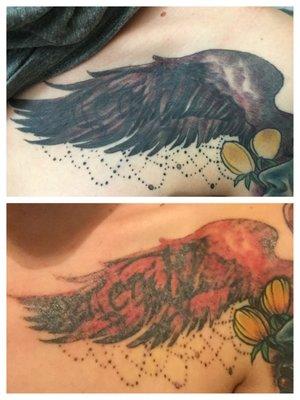 This is my before and after just one laser tattoo removal session