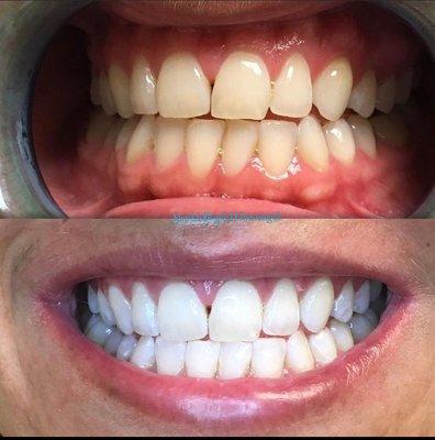 Teeth Whitening: Before & After