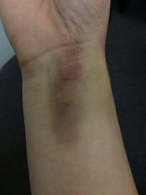 Bruising from the IV in like 6 diff spots