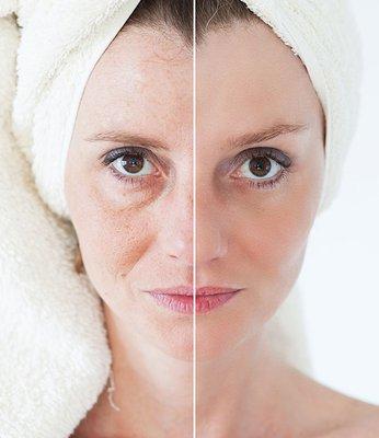 Skin Tightening