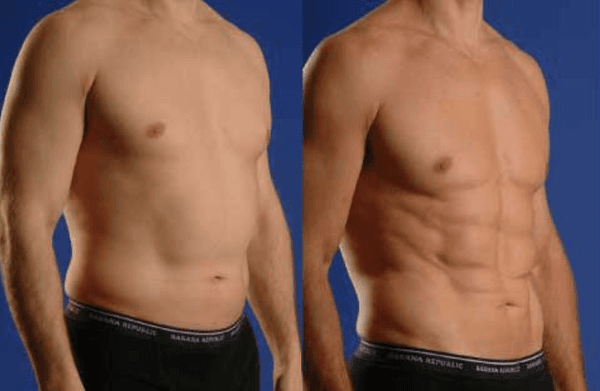 VASER Hi-Def Liposuction (Real Patient)