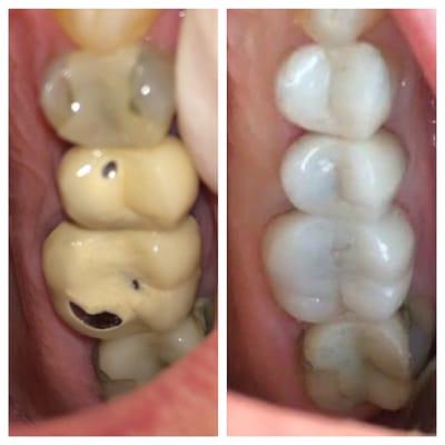 replacing old failing porcelain/metal crowns with all ceramic e.max crowns