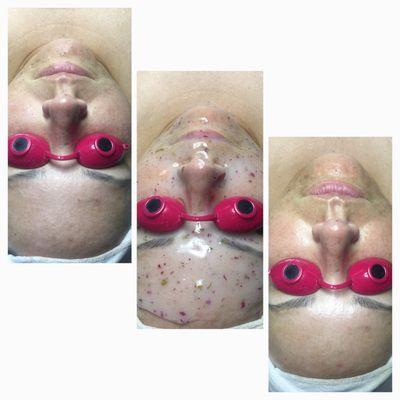 Dermaplane + oxygen Vitamin ACE infusion + Hydrojelly mask. Revitalizing and hydrating!