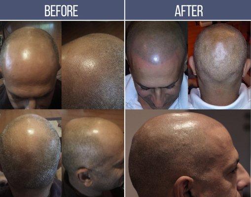 Scalp Micro-pigmentation Full Head