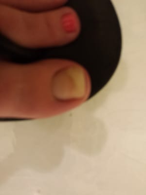 The nail fungus I got from their pedicure.