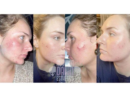 Before and After Acne Bootcamp