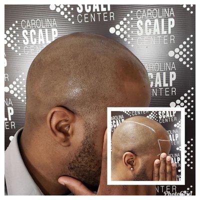 Helping this young man regain his confidence and freedom from hair loss with Scalp Micropigmentation!