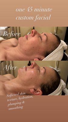 Before and after custom facial