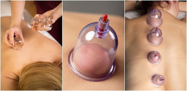 Cupping for helping better circulation