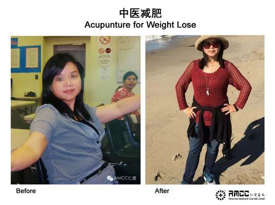 Acupuncture for weight lose after 3 months of treatments