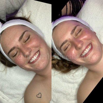 Before Vs After Hydrating Facial