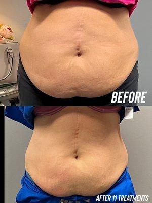 Result of 11 CryoSlimming treatment