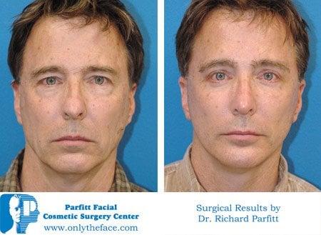 Male Face Lift WI by Dr. Parfitt