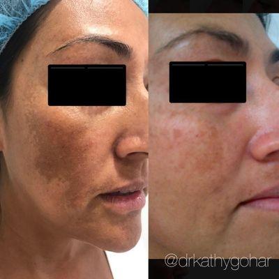 Fraxel laser before and after