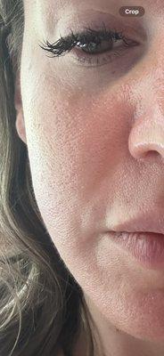 Over 3 weeks after microneedling.