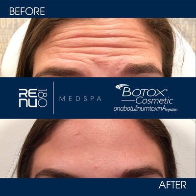 #Botox at Re:nu 180 Medspa