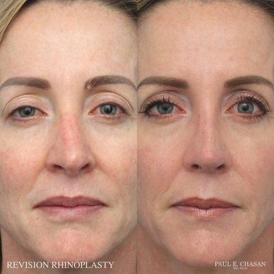 Revision Rhinoplasty by Dr. Paul Chasan