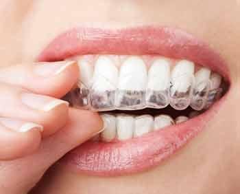 At-home whitening systems from dentists work faster than OTC options, and custom trays fit teeth perfectly. We offer $99 Whitening for Life.