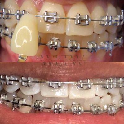 Safe on braces