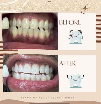 Professional teeth whitening, same days results. Pain free