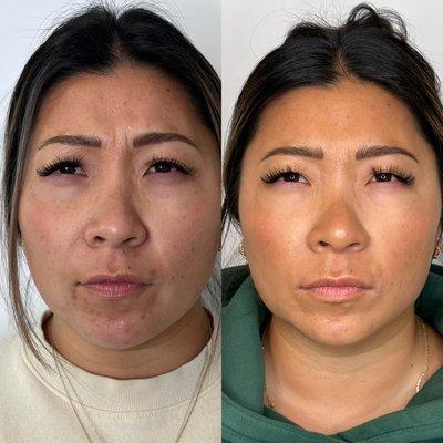 Frown line (11's) Botox treatment #botox