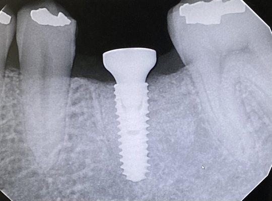 Implant is the best option without sacrificing adjacent teeth enamel. Check Implant vs Bridge