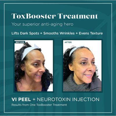 combination of Botox and Vi peel