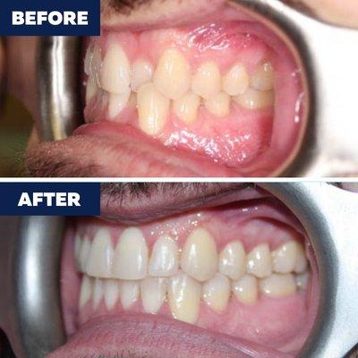 Invisalign used to treat severe crowding and crossbite. Call us to schedule a consultation!...