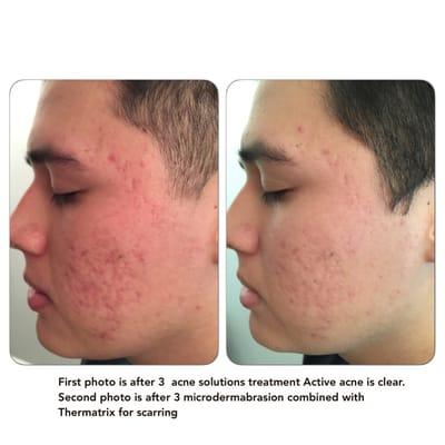 Smooth and correct Acne Scars