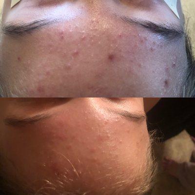 Before and after acne facial!