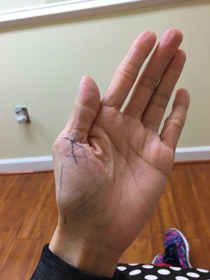 The doctor painted my hand where it hurts