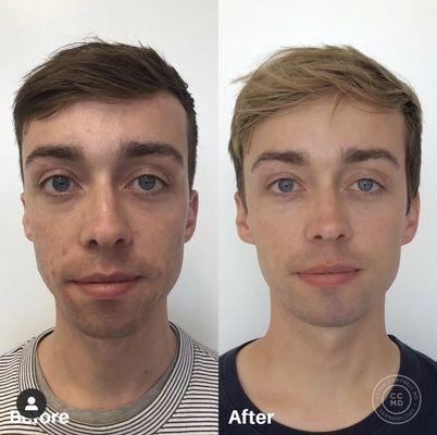 Before and after, just a few months into my acne treatments with Dr. Campbell