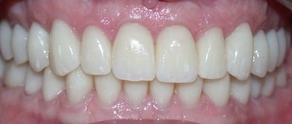 After Bioesthetic Dentistry