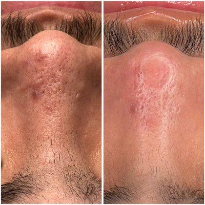 Before and after mens facial