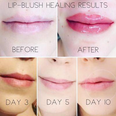 Full lips procedure before and after.