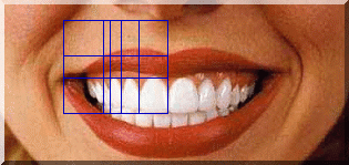 We use natural proportion to plan our smile designs.