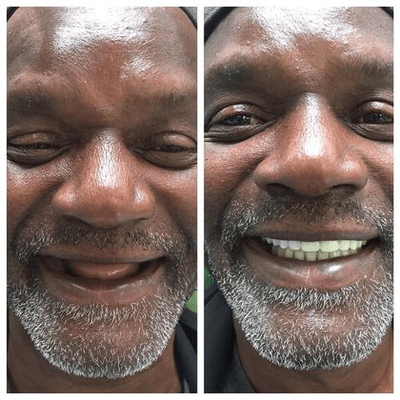 Before and After at NÜVA Smile | Wyckoff, NJ