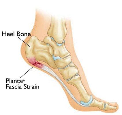 Same day treatment for Heel pain and plantar Fasciitis.