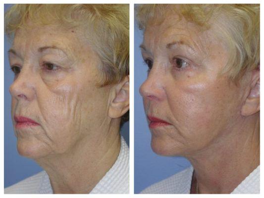 Face Lift and Fat Grafting Before and After Results by Haven J. Barlow, MD, FACS