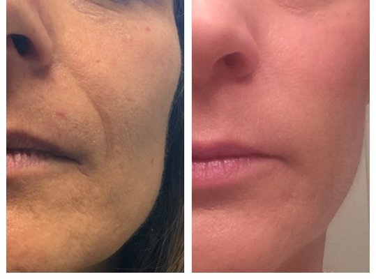 Dermal Filler  for smile lines  before and after!