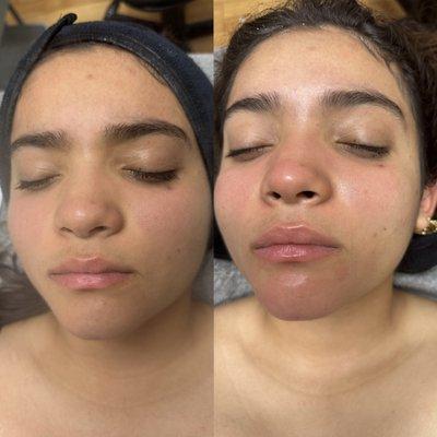 Amazing customized teen facial with led light treatment