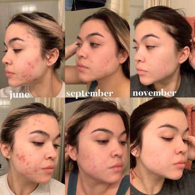 Acne treatment success takes time and patience but totally worth it.