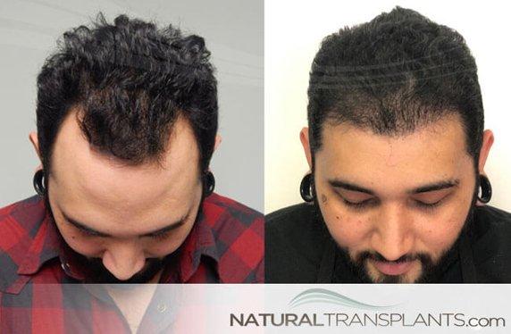 Call Us 844-327-HAIR (4247) | https://naturaltransplants.com/ Hair Transplant Without Surgery