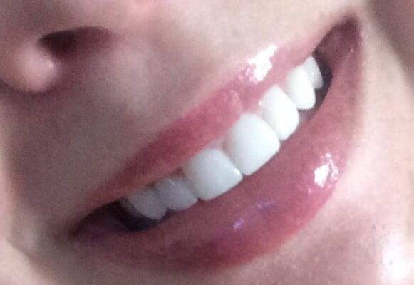 My teeth close up after they had redone my veneers... Very white and natural looking