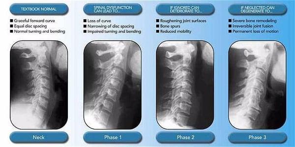 Phases of Spinal Degeneration