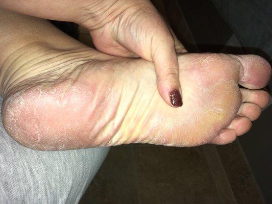 As you can see very careful attention paid to callus removal!!! NOT