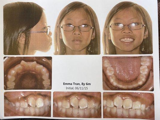 Her stages of braces